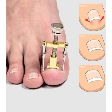 Ingrown toenail concealer, 1 pc. 2