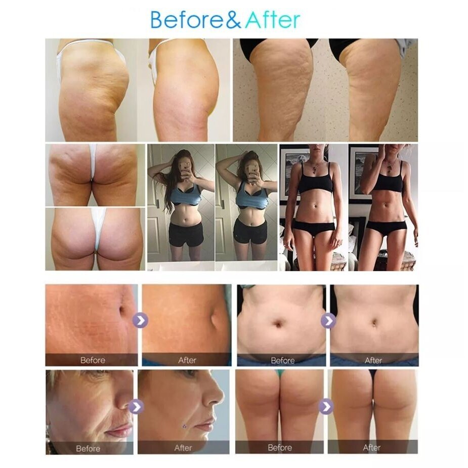 VELASHAPE professional vacuum, IR, cavitation and radio frequency device 4in1 8 VELASHAPE professional vacuum, IR, cavitation and radio frequency device 4in1 8